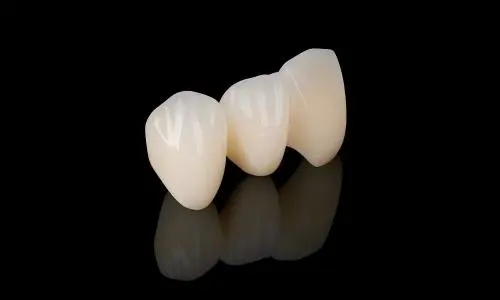 What Are the Benefits of White Gold PFM Crowns for Anterior Restorations?